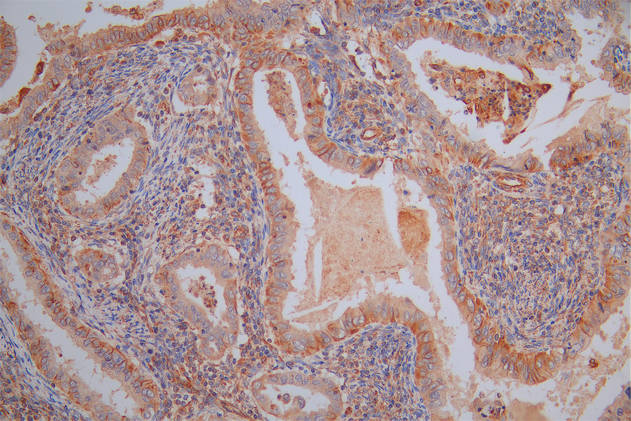 IHC image of CSB-RA025857MA1HU diluted at 1:40 and staining in paraffin-embedded human endometrial cancer performed on a Leica BondTM system. After dewaxing and hydration, antigen retrieval was mediated by high pressure in a citrate buffer (pH 6.0). Section was blocked with 10% normal goat serum 30min at RT. Then primary antibody (1% BSA) was incubated at 4°C overnight. The primary is detected by a Goat anti-Rabbit IgG labeled by HRP and visualized using 0.05% DAB.