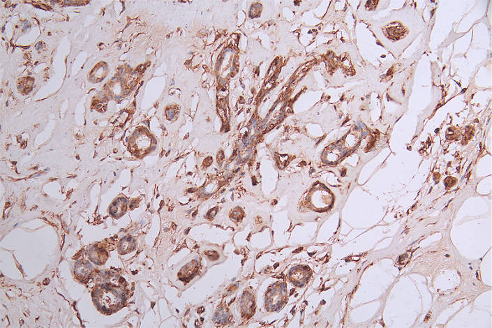 IHC image of CSB-RA029079A0HU diluted at 1:50 and staining in paraffin-embedded human breast cancer performed on a Leica BondTM system. After dewaxing and hydration, antigen retrieval was mediated by high pressure in a citrate buffer (pH 6.0). Section was blocked with 10% normal goat serum 30min at RT. Then primary antibody (1% BSA) was incubated at 4°C overnight. The primary is detected by a Goat anti-rabbit polymer IgG labeled by HRP and visualized using 0.35% DAB.