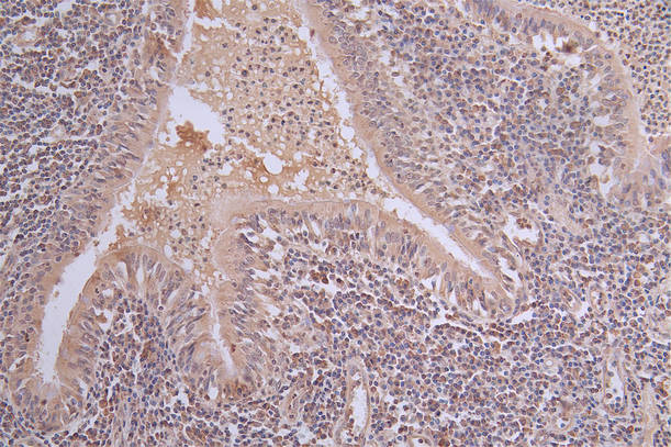 IHC image of CSB-RA101461A0HU diluted at 1:50 and staining in paraffin-embedded human lung tissue performed on a Leica BondTM system. After dewaxing and hydration, antigen retrieval was mediated by high pressure in a citrate buffer (pH 6.0). Section was blocked with 10% normal goat serum 30min at RT. Then primary antibody (1% BSA) was incubated at 4°C overnight. The primary is detected by a Goat anti-rabbit polymer IgG labeled by HRP and visualized using 0.63% DAB.