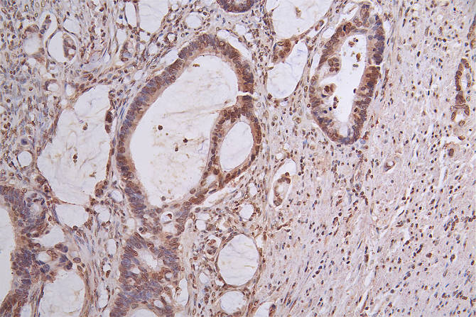 IHC image of CSB-RA101461A0HU diluted at 1:50 and staining in paraffin-embedded human rectal cancer performed on a Leica BondTM system. After dewaxing and hydration, antigen retrieval was mediated by high pressure in a citrate buffer (pH 6.0). Section was blocked with 10% normal goat serum 30min at RT. Then primary antibody (1% BSA) was incubated at 4°C overnight. The primary is detected by a Goat anti-rabbit polymer IgG labeled by HRP and visualized using 0.63% DAB.