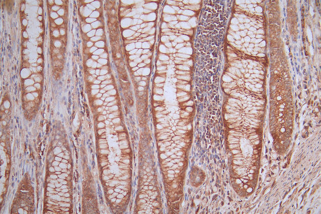 IHC image of CSB-RA116135A0HU diluted at 1:50 and staining in paraffin-embedded human rectal cancer performed on a Leica BondTM system. After dewaxing and hydration, antigen retrieval was mediated by high pressure in a citrate buffer (pH 6.0). Section was blocked with 10% normal goat serum 30min at RT. Then primary antibody (1% BSA) was incubated at 4°C overnight. The primary is detected by a Goat anti-rabbit polymer IgG labeled by HRP and visualized using 0.53% DAB.