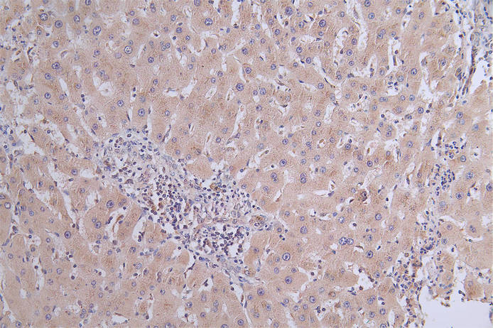 IHC image of CSB-RA119753A0HU diluted at 1:50 and staining in paraffin-embedded human liver cancer performed on a Leica BondTM system. After dewaxing and hydration, antigen retrieval was mediated by high pressure in a citrate buffer (pH 6.0). Section was blocked with 10% normal goat serum 30min at RT. Then primary antibody (1% BSA) was incubated at 4°C overnight. The primary is detected by a Goat anti-rabbit polymer IgG labeled by HRP and visualized using 0.31% DAB.