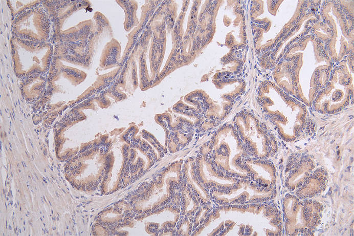 IHC image of CSB-RA130853A0HU diluted at 1:50 and staining in paraffin-embedded human prostate tissue performed on a Leica BondTM system. After dewaxing and hydration, antigen retrieval was mediated by high pressure in a citrate buffer (pH 6.0). Section was blocked with 10% normal goat serum 30min at RT. Then primary antibody (1% BSA) was incubated at 4°C overnight. The primary is detected by a Goat anti-rabbit polymer IgG labeled by HRP and visualized using 0.45% DAB.