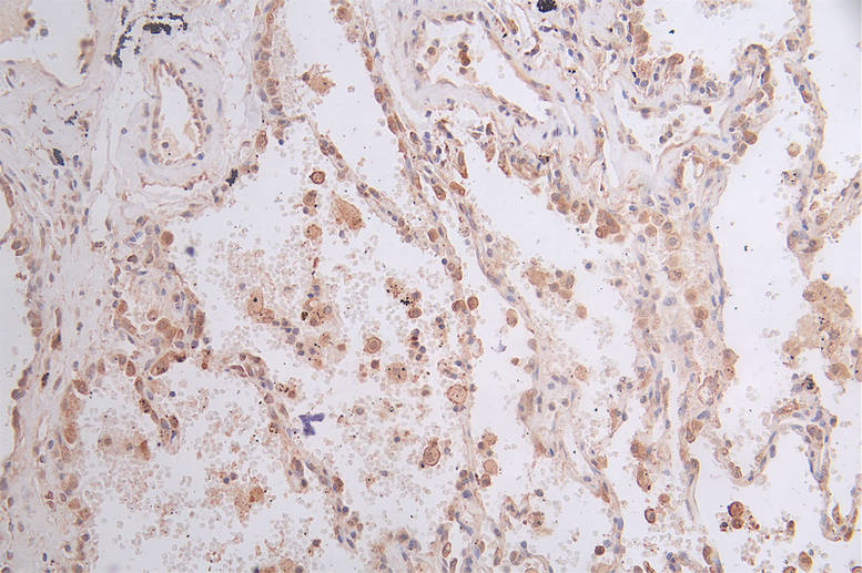 IHC image of CSB-RA130853A0HU diluted at 1:50 and staining in paraffin-embedded human lung cancer performed on a Leica BondTM system. After dewaxing and hydration, antigen retrieval was mediated by high pressure in a citrate buffer (pH 6.0). Section was blocked with 10% normal goat serum 30min at RT. Then primary antibody (1% BSA) was incubated at 4°C overnight. The primary is detected by a Goat anti-rabbit polymer IgG labeled by HRP and visualized using 0.45% DAB.