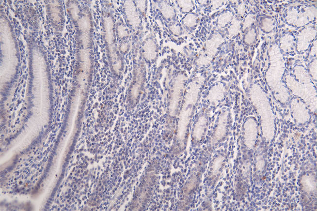 IHC image of CSB-RA148519A0HU diluted at 1:100 and staining in paraffin-embedded human breast cancer performed on a Leica BondTM system. After dewaxing and hydration, antigen retrieval was mediated by high pressure in a citrate buffer (pH 6.0). Section was blocked with 10% normal goat serum 30min at RT. Then primary antibody (1% BSA) was incubated at 4°C overnight. The primary is detected by a Goat anti-rabbit polymer IgG labeled by HRP and visualized using 0.09% DAB.