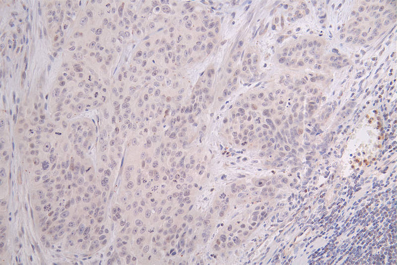 IHC image of CSB-RA148519A0HU diluted at 1:100 and staining in paraffin-embedded human gastric cancer performed on a Leica BondTM system. After dewaxing and hydration, antigen retrieval was mediated by high pressure in a citrate buffer (pH 6.0). Section was blocked with 10% normal goat serum 30min at RT. Then primary antibody (1% BSA) was incubated at 4°C overnight. The primary is detected by a Goat anti-rabbit polymer IgG labeled by HRP and visualized using 0.09% DAB.