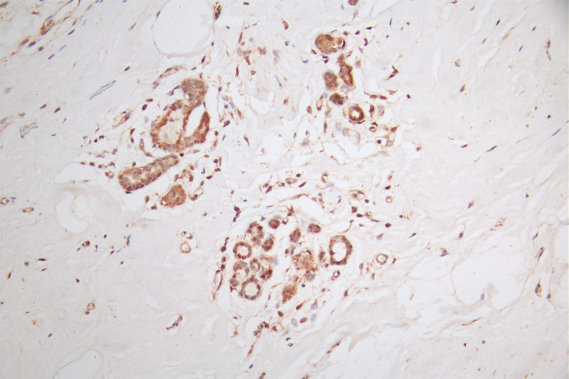 IHC image of CSB-RA150369A0HU diluted at 1:50 and staining in paraffin-embedded human breast cancer performed on a Leica BondTM system. After dewaxing and hydration, antigen retrieval was mediated by high pressure in a citrate buffer (pH 6.0). Section was blocked with 10% normal goat serum 30min at RT. Then primary antibody (1% BSA) was incubated at 4°C overnight. The primary is detected by a Goat anti-rabbit polymer IgG labeled by HRP and visualized using 0.58% DAB.