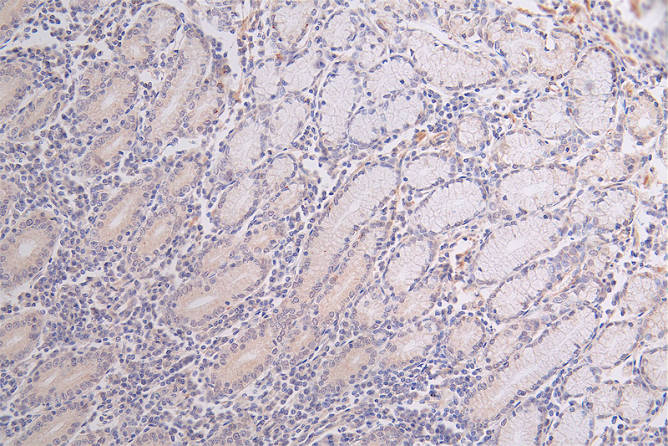 IHC image of CSB-RA18201:50A0HU diluted at 1:50 and staining in paraffin-embedded human breast cancer performed on a Leica BondTM system. After dewaxing and hydration, antigen retrieval was mediated by high pressure in a citrate buffer (pH 6.0). Section was blocked with 10% normal goat serum 30min at RT. Then primary antibody (1% BSA) was incubated at 4°C overnight. The primary is detected by a Goat anti-rabbit polymer IgG labeled by HRP and visualized using 0.60% DAB.