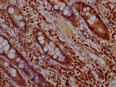 IHC image of CSB-RA187762A0HU diluted at 1:100 and staining in paraffin-embedded human colon cancer performed on a Leica BondTM system. After dewaxing and hydration, antigen retrieval was mediated by high pressure in a citrate buffer (pH 6.0). Section was blocked with 10% normal goat serum 30min at RT. Then primary antibody (1% BSA) was incubated at 4°C overnight. The primary is detected by a Goat anti-rabbit IgG polymer labeled by HRP and visualized using 0.05% DAB.