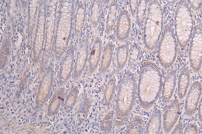 IHC image of CSB-RA197122A0HU diluted at 1:50 and staining in paraffin-embedded human rectal cancer performed on a Leica BondTM system. After dewaxing and hydration, antigen retrieval was mediated by high pressure in a citrate buffer (pH 6.0). Section was blocked with 10% normal goat serum 30min at RT. Then primary antibody (1% BSA) was incubated at 4°C overnight. The primary is detected by a Goat anti-rabbit polymer IgG labeled by HRP and visualized using 0.47% DAB.