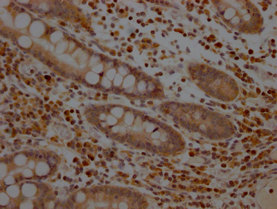 IHC image of CSB-RA225579A0HU diluted at 1:100 and staining in paraffin-embedded human colon cancer performed on a Leica BondTM system. After dewaxing and hydration, antigen retrieval was mediated by high pressure in a citrate buffer (pH 6.0). Section was blocked with 10% normal goat serum 30min at RT. Then primary antibody (1% BSA) was incubated at 4°C overnight. The primary is detected by a Goat anti-rabbit IgG polymer labeled by HRP and visualized using 0.05% DAB.