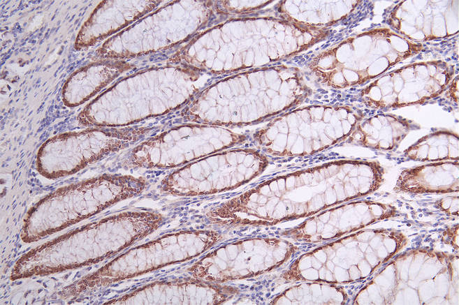 IHC image of CSB-RA249987A0HU diluted at 1:50 and staining in paraffin-embedded human rectal cancer performed on a Leica BondTM system. After dewaxing and hydration, antigen retrieval was mediated by high pressure in a citrate buffer (pH 6.0). Section was blocked with 10% normal goat serum 30min at RT. Then primary antibody (1% BSA) was incubated at 4°C overnight. The primary is detected by a Goat anti-rabbit polymer IgG labeled by HRP and visualized using 0.68% DAB.