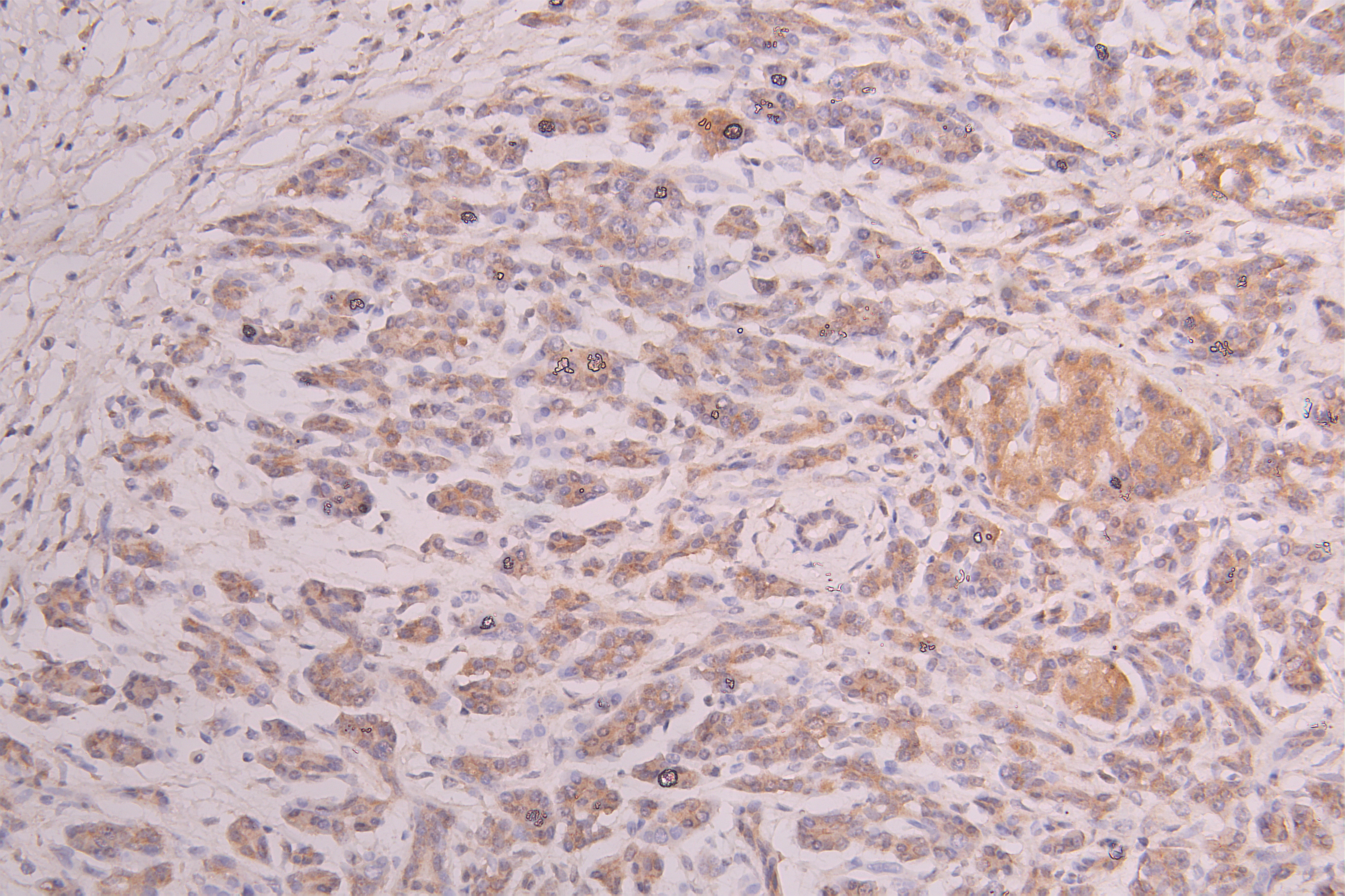 IHC image of CSB-RA356436MA1HU diluted at 1:100 and staining in paraffin-embedded human pancreatic cancer performed on a Leica BondTM system. After dewaxing and hydration, antigen retrieval was mediated by high pressure in a citrate buffer (pH 6.0). Section was blocked with 10% normal goat serum 30min at RT. Then primary antibody (1% BSA) was incubated at 4°C overnight. The primary is detected by a Goat anti-Human IgG labeled by HRP and visualized using 0.05% DAB.