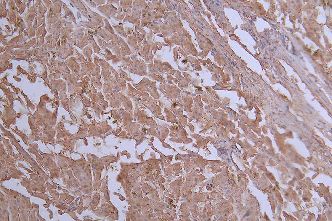 IHC image of CSB-RA438622A0HU diluted at 1:50 and staining in paraffin-embedded human liver cancer performed on a Leica BondTM system. After dewaxing and hydration, antigen retrieval was mediated by high pressure in a citrate buffer (pH 6.0). Section was blocked with 10% normal goat serum 30min at RT. Then primary antibody (1% BSA) was incubated at 4°C overnight. The primary is detected by a Goat anti-rabbit polymer IgG labeled by HRP and visualized using 0.20% DAB.