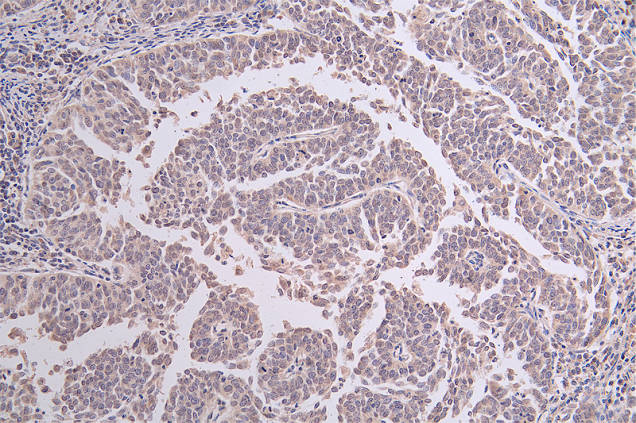 IHC image of CSB-RA442393A0HU diluted at 1:50 and staining in paraffin-embedded human cervical cancer performed on a Leica BondTM system. After dewaxing and hydration, antigen retrieval was mediated by high pressure in a citrate buffer (pH 6.0). Section was blocked with 10% normal goat serum 30min at RT. Then primary antibody (1% BSA) was incubated at 4°C overnight. The primary is detected by a Goat anti-rabbit polymer IgG labeled by HRP and visualized using 0.46% DAB.