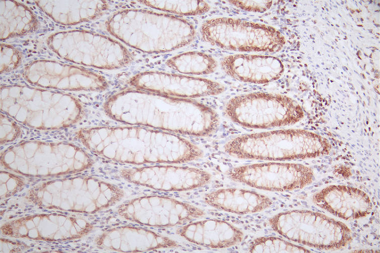 IHC image of CSB-RA561630A0HU diluted at 1:50 and staining in paraffin-embedded human rectal cancer performed on a Leica BondTM system. After dewaxing and hydration, antigen retrieval was mediated by high pressure in a citrate buffer (pH 6.0). Section was blocked with 10% normal goat serum 30min at RT. Then primary antibody (1% BSA) was incubated at 4°C overnight. The primary is detected by a Goat anti-rabbit polymer IgG labeled by HRP and visualized using 0.52% DAB.