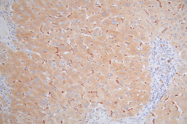 IHC image of CSB-RA574653A0HU diluted at 1:80 and staining in paraffin-embedded human liver cancer performed on a Leica BondTM system. After dewaxing and hydration, antigen retrieval was mediated by high pressure in a citrate buffer (pH 6.0). Section was blocked with 10% normal goat serum 30min at RT. Then primary antibody (1% BSA) was incubated at 4°C overnight. The primary is detected by a Goat anti-rabbit polymer IgG labeled by HRP and visualized using 0.49% DAB.