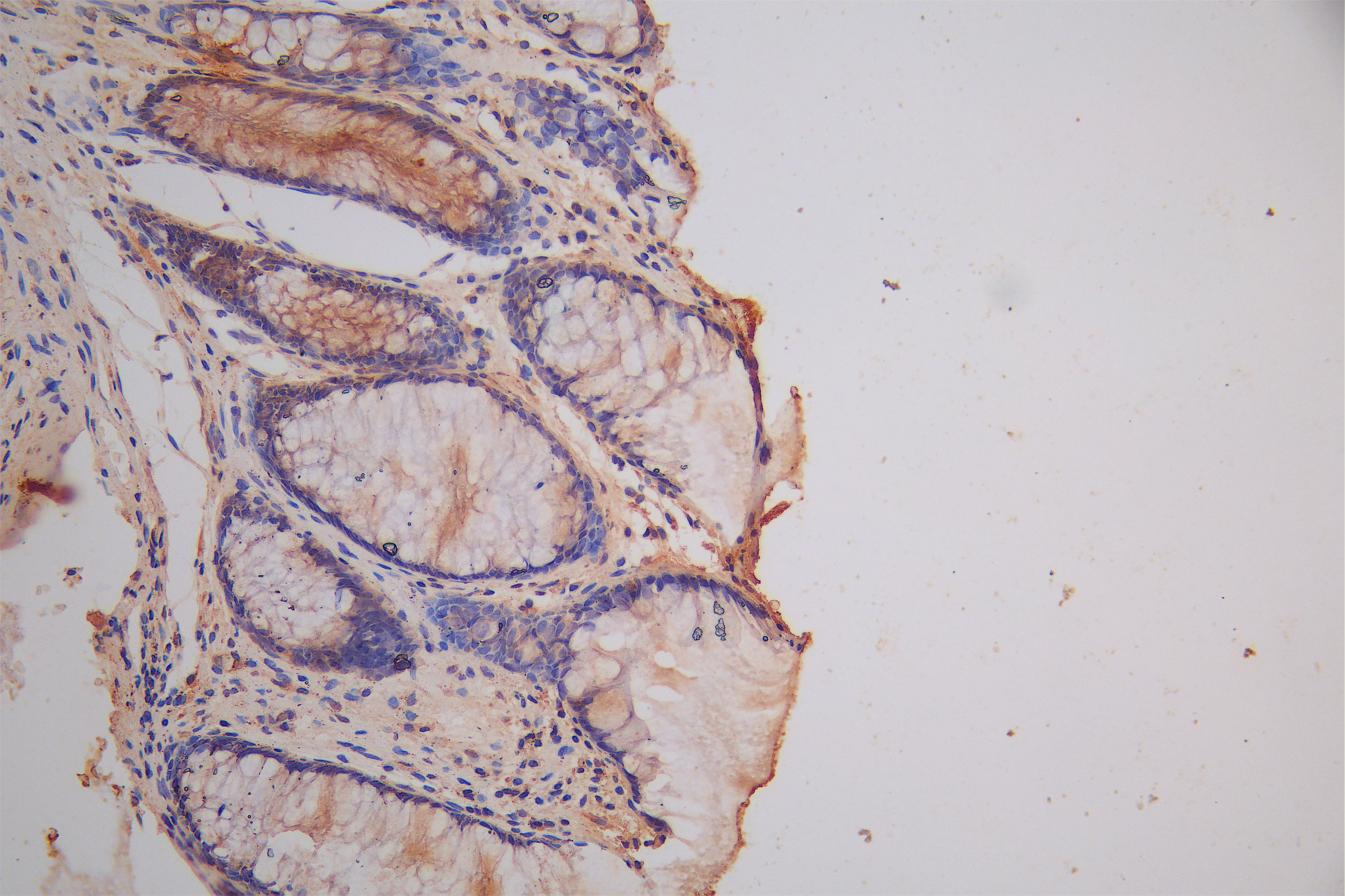 IHC image of CSB-RA614975MA1HU diluted at 1:150 and staining in paraffin-embedded human colorectal cancer performed on a Leica BondTM system. After dewaxing and hydration, antigen retrieval was mediated by high pressure in a citrate buffer (pH 6.0). Section was blocked with 10% normal goat serum 30min at RT. Then primary antibody (1% BSA) was incubated at 4°C overnight. The primary is detected by a Goat anti-Rabbit IgG labeled by HRP and visualized using 0.05% DAB.