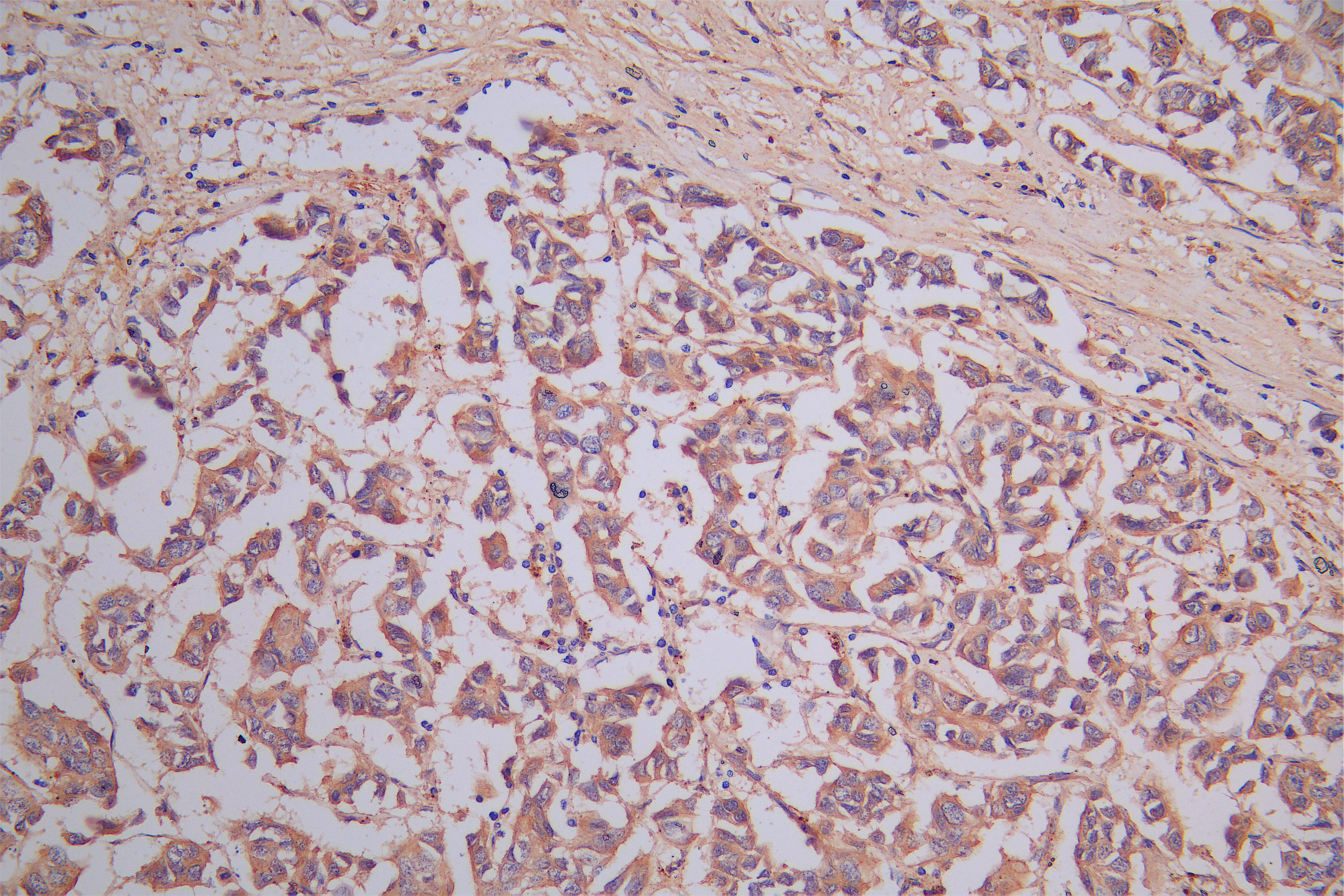 IHC image of CSB-RA614975MA1HU diluted at 1:150 and staining in paraffin-embedded human breast cancer performed on a Leica BondTM system. After dewaxing and hydration, antigen retrieval was mediated by high pressure in a citrate buffer (pH 6.0). Section was blocked with 10% normal goat serum 30min at RT. Then primary antibody (1% BSA) was incubated at 4°C overnight. The primary is detected by a Goat anti-Rabbit IgG labeled by HRP and visualized using 0.05% DAB.