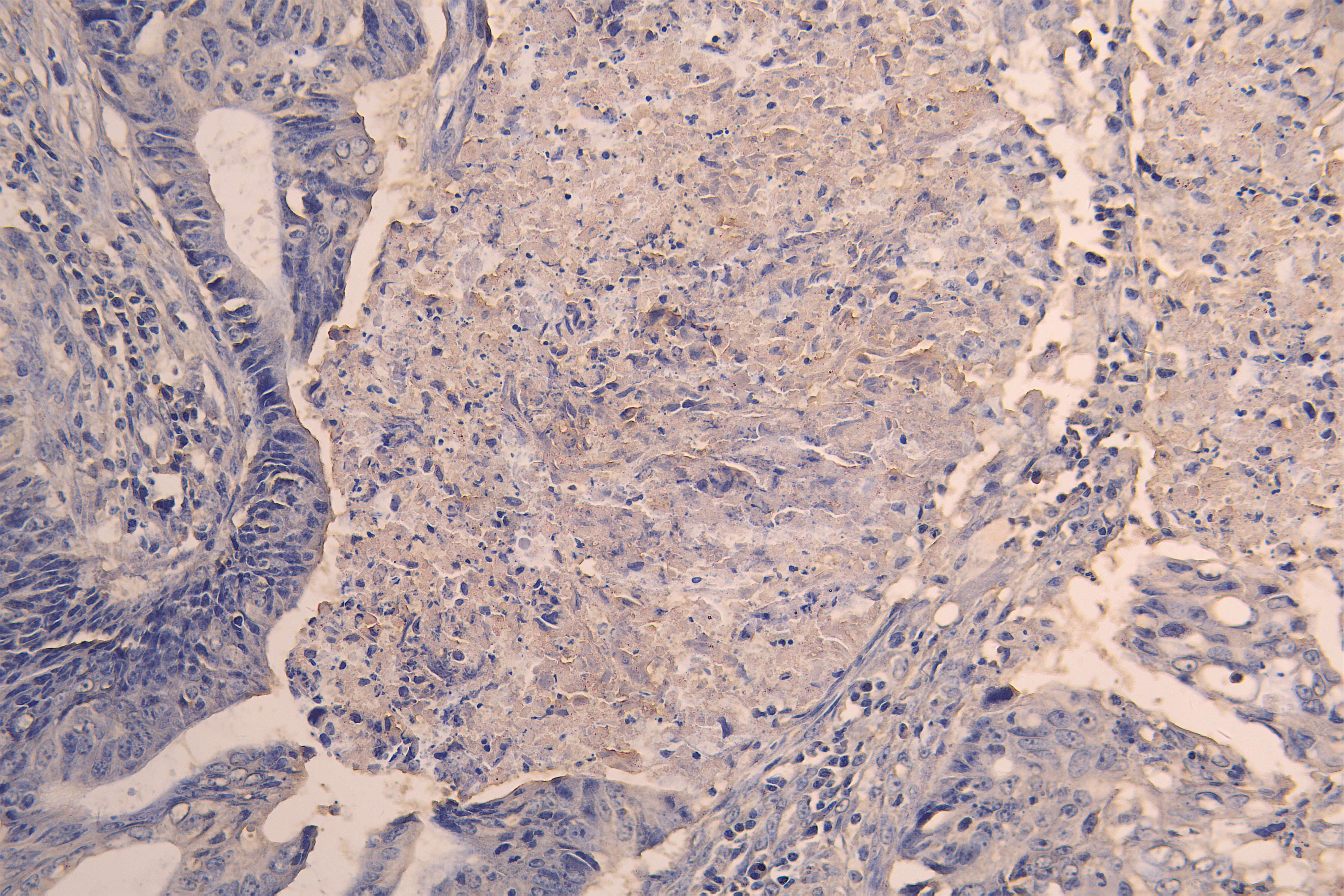 IHC image of CSB-RA623829MA1HU diluted at 1:200 and staining in paraffin-embedded human colon cancer performed on a Leica BondTM system. After dewaxing and hydration, antigen retrieval was mediated by high pressure in a citrate buffer (pH 6.0). Section was blocked with 10% normal goat serum 30min at RT. Then primary antibody (1% BSA) was incubated at 4°C overnight. The primary is detected by a Goat anti-human polymer IgG labeled by HRP and visualized using 0.05% DAB.