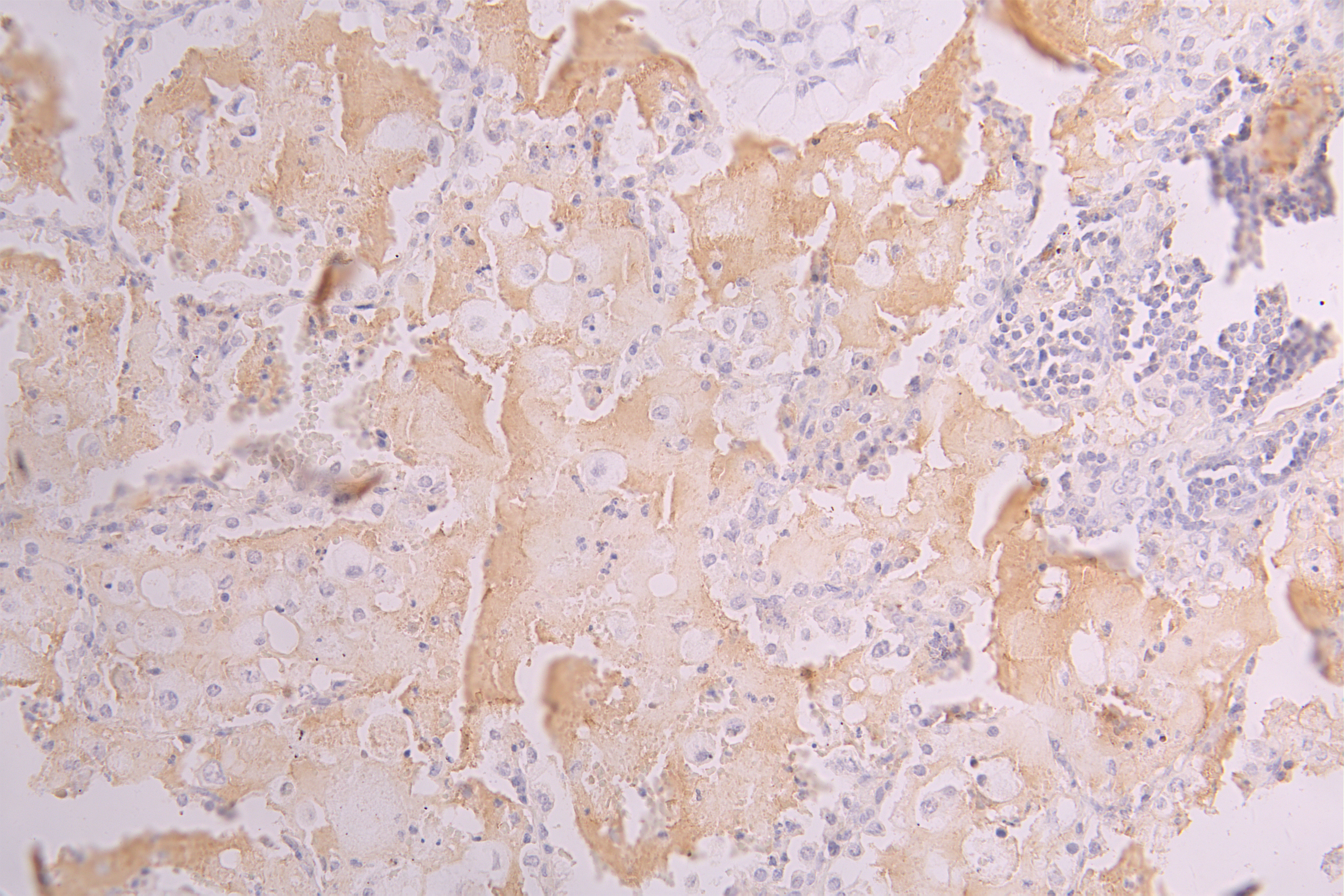 IHC image of CSB-RA624122MA1HU diluted at 1 : 150 and staining in paraffin-embedded human lung tissue performed on a Leica BondTM system. After dewaxing and hydration, antigen retrieval was mediated by high pressure in a citrate buffer (pH 6.0). Section was blocked with 10% normal goat serum 30min at RT. Then primary antibody (1% BSA) was incubated at 4°C overnight. The primary is detected by a Goat anti-human polymer IgG labeled by HRP and visualized using 0.05% DAB.