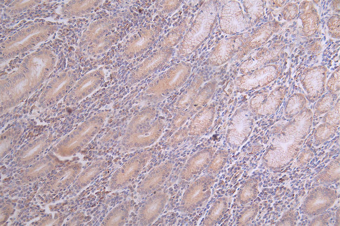 IHC image of CSB-RA782732A0HU diluted at 1:100 and staining in paraffin-embedded human breast cancer performed on a Leica BondTM system. After dewaxing and hydration, antigen retrieval was mediated by high pressure in a citrate buffer (pH 6.0). Section was blocked with 10% normal goat serum 30min at RT. Then primary antibody (1% BSA) was incubated at 4°C overnight. The primary is detected by a Goat anti-rabbit polymer IgG labeled by HRP and visualized using 0.69% DAB.