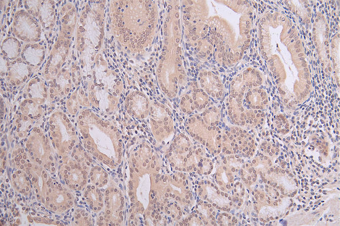 IHC image of CSB-RA792403A0HU diluted at 1:100 and staining in paraffin-embedded human gastric cancer performed on a Leica BondTM system. After dewaxing and hydration, antigen retrieval was mediated by high pressure in a citrate buffer (pH 6.0). Section was blocked with 10% normal goat serum 30min at RT. Then primary antibody (1% BSA) was incubated at 4°C overnight. The primary is detected by a Goat anti-rabbit polymer IgG labeled by HRP and visualized using 0.06% DAB.