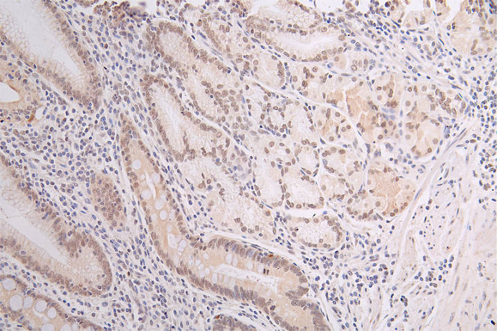 IHC image of CSB-RA796958A0HU diluted at 1:50 and staining in paraffin-embedded human gastric cancer performed on a Leica BondTM system. After dewaxing and hydration, antigen retrieval was mediated by high pressure in a citrate buffer (pH 6.0). Section was blocked with 10% normal goat serum 30min at RT. Then primary antibody (1% BSA) was incubated at 4°C overnight. The primary is detected by a Goat anti-rabbit polymer IgG labeled by HRP and visualized using 0.67% DAB.