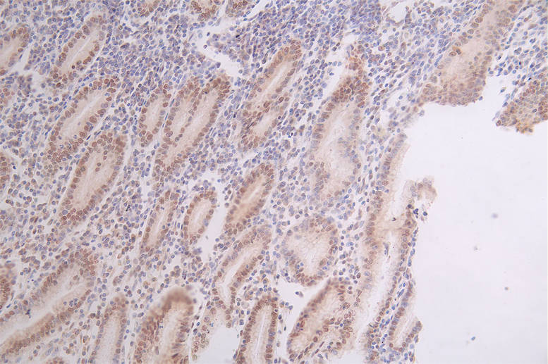 IHC image of CSB-RA796958A0HU diluted at 1:50 and staining in paraffin-embedded human breast cancer performed on a Leica BondTM system. After dewaxing and hydration, antigen retrieval was mediated by high pressure in a citrate buffer (pH 6.0). Section was blocked with 10% normal goat serum 30min at RT. Then primary antibody (1% BSA) was incubated at 4°C overnight. The primary is detected by a Goat anti-rabbit polymer IgG labeled by HRP and visualized using 0.67% DAB.