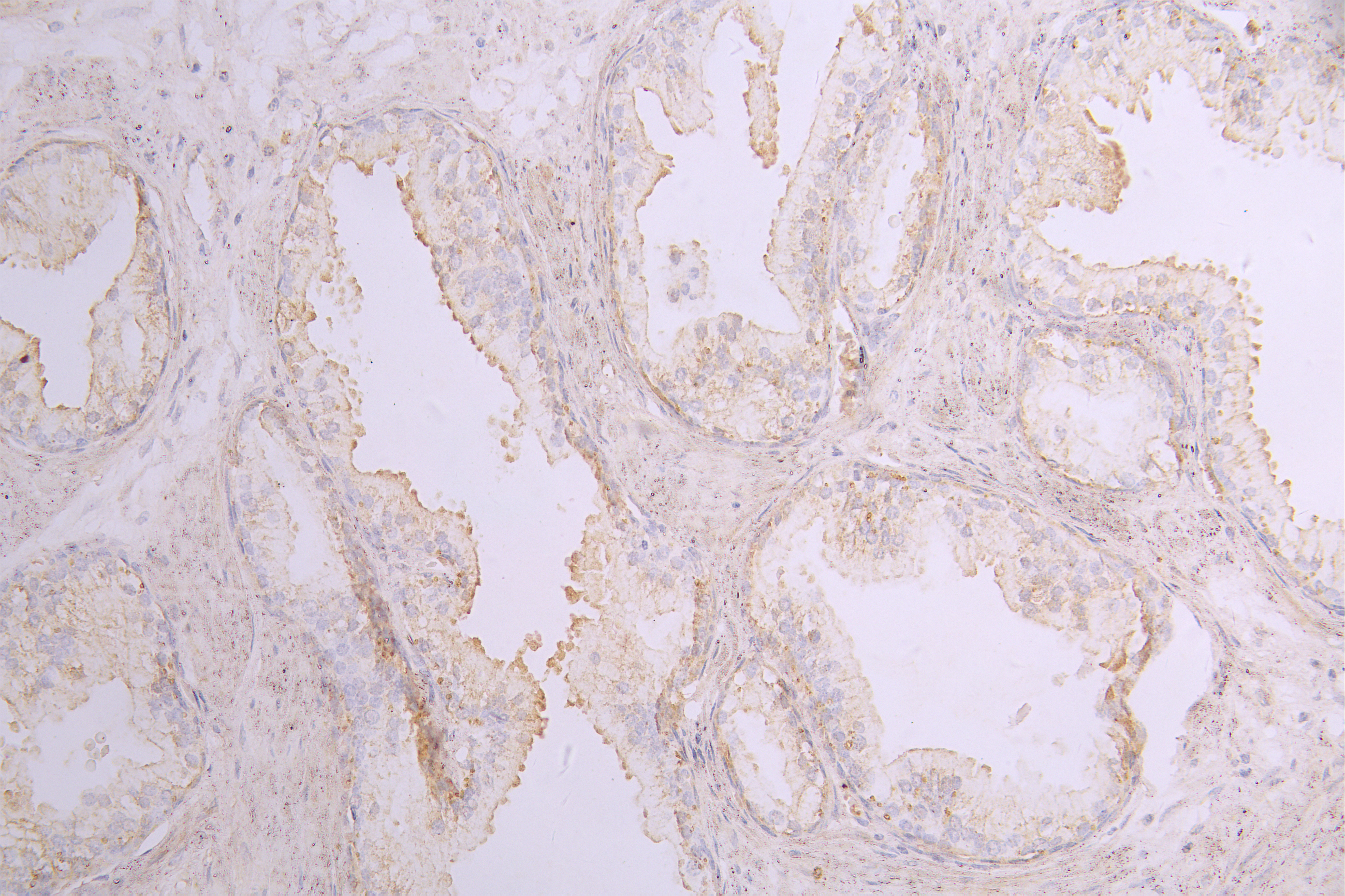 IHC image of CSB-RA859530MA1HU diluted at 1 : 100 and staining in paraffin-embedded human prostate cancer performed on a Leica BondTM system. After dewaxing and hydration, antigen retrieval was mediated by high pressure in a citrate buffer (pH 6.0). Section was blocked with 10% normal goat serum 30min at RT. Then primary antibody (1% BSA) was incubated at 4°C overnight. The primary is detected by a Goat anti-human polymer IgG labeled by HRP and visualized using 0.05% DAB.