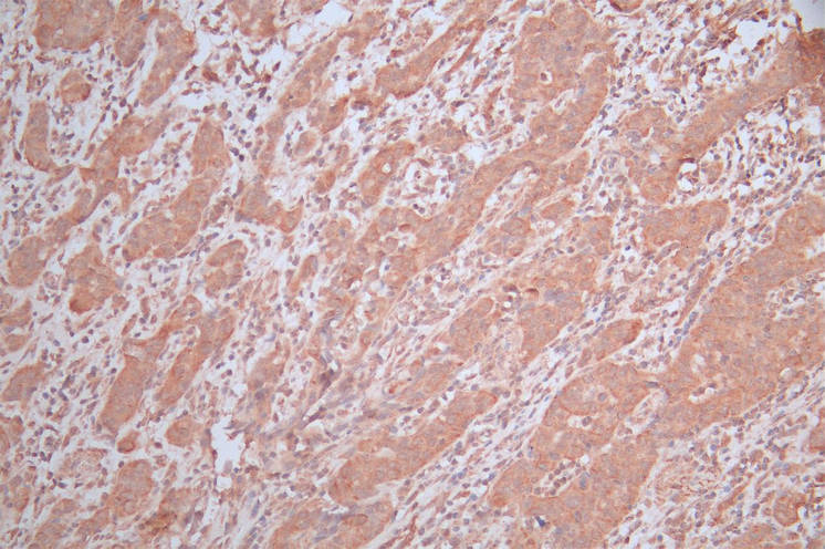 IHC image of CSB-RA892357MA1HU diluted at 1:600 and staining in paraffin-embedded human bladder cancer performed on a Leica BondTM system. After dewaxing and hydration, antigen retrieval was mediated by high pressure in a citrate buffer (pH 6.0). Section was blocked with 10% normal goat serum 30min at RT. Then primary antibody (1% BSA) was incubated at 4°C overnight. The primary is detected by a Goat anti-Mouse IgG labeled by HRP and visualized using 0.05% DAB.