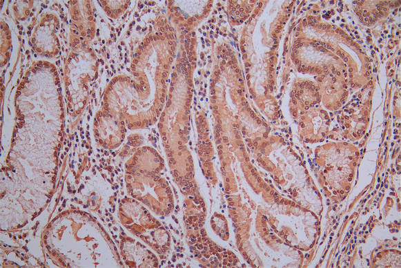 IHC image of CSB-RA896760MA1HU diluted at 1:30 and staining in paraffin-embedded human gastric cancer performed on a Leica BondTM system. After dewaxing and hydration, antigen retrieval was mediated by high pressure in a citrate buffer (pH 6.0). Section was blocked with 10% normal goat serum 30min at RT. Then primary antibody (1% BSA) was incubated at 4°C overnight. The primary is detected by a Goat anti-Mouse IgG labeled by HRP and visualized using 0.05% DAB.