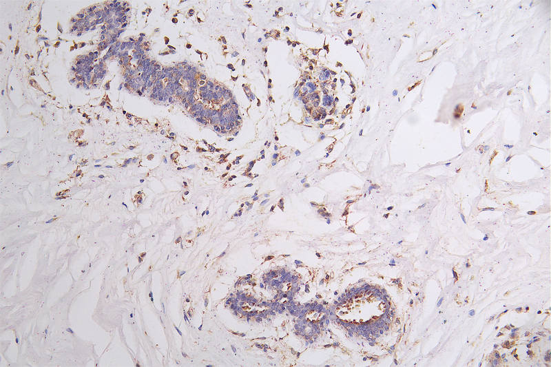 IHC image of CSB-RA940669A0HU diluted at 1:100 and staining in paraffin-embedded human breast cancer performed on a Leica BondTM system. After dewaxing and hydration, antigen retrieval was mediated by high pressure in a citrate buffer (pH 6.0). Section was blocked with 10% normal goat serum 30min at RT. Then primary antibody (1% BSA) was incubated at 4°C overnight. The primary is detected by a Goat anti-rabbit polymer IgG labeled by HRP and visualized using 0.21% DAB.