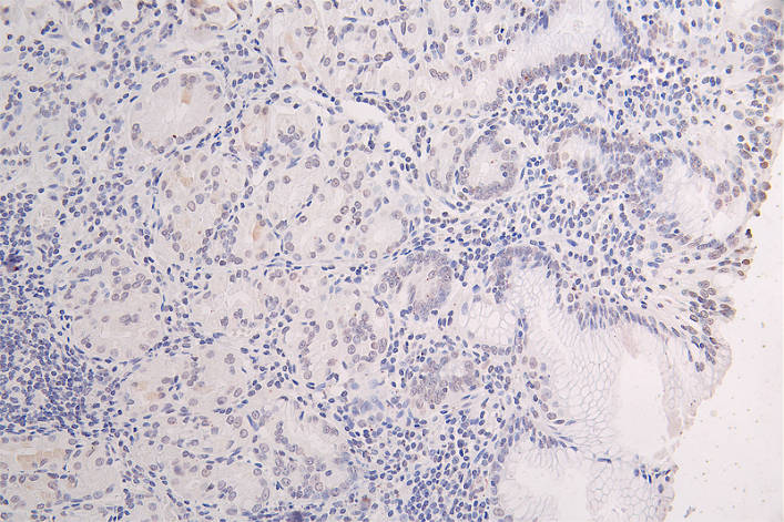 IHC image of CSB-RA943659A0HU diluted at 1:100 and staining in paraffin-embedded human gastric cancer performed on a Leica BondTM system. After dewaxing and hydration, antigen retrieval was mediated by high pressure in a citrate buffer (pH 6.0). Section was blocked with 10% normal goat serum 30min at RT. Then primary antibody (1% BSA) was incubated at 4°C overnight. The primary is detected by a Goat anti-rabbit polymer IgG labeled by HRP and visualized using 0.08% DAB.