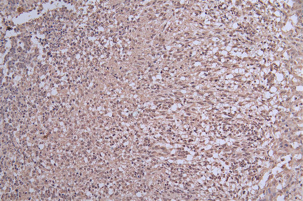 IHC image of CSB-RA956089A0HU diluted at 1:50 and staining in paraffin-embedded human glioma cancer performed on a Leica BondTM system. After dewaxing and hydration, antigen retrieval was mediated by high pressure in a citrate buffer (pH 6.0). Section was blocked with 10% normal goat serum 30min at RT. Then primary antibody (1% BSA) was incubated at 4°C overnight. The primary is detected by a Goat anti-rabbit polymer IgG labeled by HRP and visualized using 0.29% DAB.