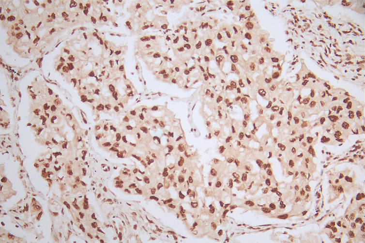 IHC image of CSB-RA980583A0HU diluted at 1:50 and staining in paraffin-embedded human lung cancer performed on a Leica BondTM system. After dewaxing and hydration, antigen retrieval was mediated by high pressure in a citrate buffer (pH 6.0). Section was blocked with 10% normal goat serum 30min at RT. Then primary antibody (1% BSA) was incubated at 4°C overnight. The primary is detected by a Goat anti-rabbit polymer IgG labeled by HRP and visualized using 0.57% DAB.