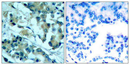 Immunohistochemical analysis of paraffin-embedded human lung carcinoma tissue using MEK1/MEK2(Ab-217/221) Antibody(left) or the same antibody preincubated with blocking peptide(right).