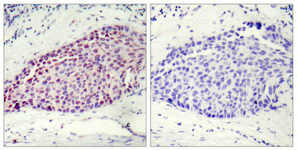 Immunohistochemical analysis of paraffin-embedded human breast carcinoma tissue using ATF2(Ab-112 or 94) Antibody(left) or the same antibody preincubated with blocking peptide(right).