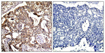 Immunohistochemical analysis of paraffin-embedded human breast carcinoma tissue using SEK1/MKK4(Ab-80) Antibody(left) or the same antibody preincubated with blocking peptide(right).