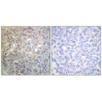 Immunohistochemistry analysis of paraffin-embedded human breast carcinoma tissue using FGFR1 (Ab-766) antiobdy.