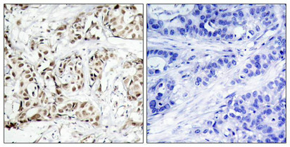 Immunohistochemical analysis of paraffin-embedded human breast carcinoma tissue using SAPK/JNK(Phospho-Thr183) Antibody(left) or the same antibody preincubated with blocking peptide(right).