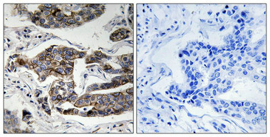 Immunohistochemical analysis of paraffin-embedded human breast carcinoma tissue using Girdin (Phospho-Ser1417) antibody (left)or the same antibody preincubated with blocking peptide (right).