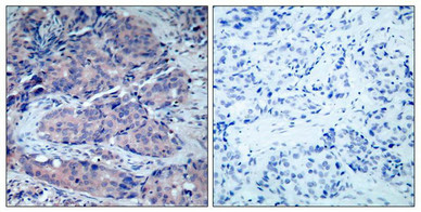 Immunohistochemical analysis of paraffin-embedded human breast carcinoma tissue using SEK1/MKK4(Ab-261) Antibody(left) or the same antibody preincubated with blocking peptide(right).