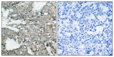 Immunohistochemical analysis of paraffin-embedded human breast carcinoma tissue using MEK1(Ab-221) Antibody(left) or the same antibody preincubated with blocking peptide(right).