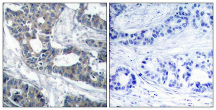 Immunohistochemical analysis of paraffin-embedded human breast carcinoma tissue using MEK1(Ab-291) Antibody(left) or the same antibody preincubated with blocking peptide(right).