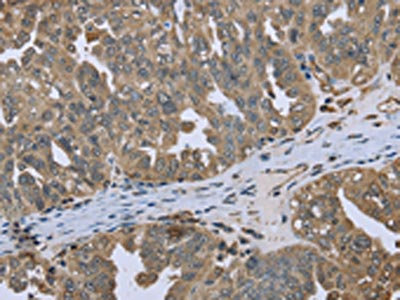 The image on the left is immunohistochemistry of paraffin-embedded Human ovarian cancer tissue using CSB-PA034013(DCTN4 Antibody) at dilution 1/50, on the right is treated with fusion protein. (Original magnification: x200)