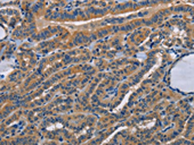 The image on the left is immunohistochemistry of paraffin-embedded Human thyroid cancer tissue using CSB-PA052910(STRADB Antibody) at dilution 1/15, on the right is treated with fusion protein. (Original magnification: x200)