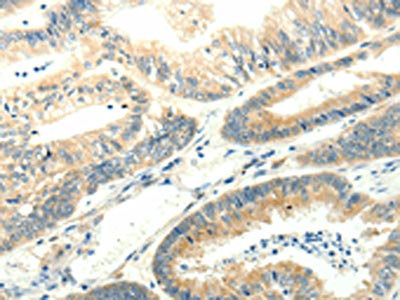 The image on the left is immunohistochemistry of paraffin-embedded Human colon cancer tissue using CSB-PA074430(SYT5 Antibody) at dilution 1/15, on the right is treated with fusion protein. (Original magnification: x200)