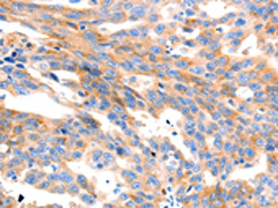 The image on the left is immunohistochemistry of paraffin-embedded Human ovarian cancer tissue using CSB-PA097880(MAP2K2 Antibody) at dilution 1/100, on the right is treated with synthetic peptide. (Original magnification: x200)