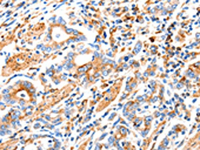 The image on the left is immunohistochemistry of paraffin-embedded Human gastic cancer tissue using CSB-PA097880(MAP2K2 Antibody) at dilution 1/100, on the right is treated with synthetic peptide. (Original magnification: x200)